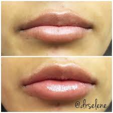 Hosts receive 10 free units of botox® for every vial or syringe of filler purchased. A Juvederm Ultra Xc One Syringe Transformation A Natural Appearing Enhancement Offering Volume And Definition Beautiful Lip Fillers Botox Lips Juvederm Lips