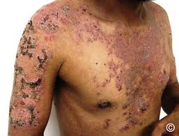 Image result for Pemphigus