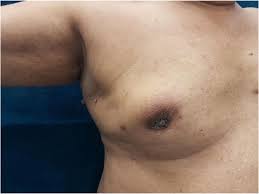 How to perform a male self breast exam begin by standing in front of a mirror with your arms on your hips to tighten your chest muscles and inspect yourself. Bilateral Synchronous Breast Cancer In Elderly Male Springerlink