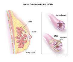 It's predictive because a positive result means you have a greatly increased risk of. Breast Cancer Medlineplus Genetics