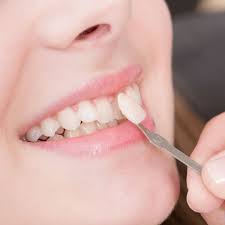Dental veneers are a common cosmetic treatment option. Veneers Glastonbury Ct Porcelain Veneers Steven M Balloch Dds