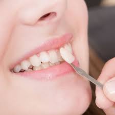 Mobasser it can surpass over 30 years. How Long Will It Take To Adjust To Veneers Palm Desert Ca