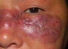 Dans ce pays, dépassé par une vague incontrôlable, plusieurs milliers de patients ont subi une mucormycose, ou champignon noir (black fingus), une infection qui peut notamment toucher les yeux et. Covid 19 Une Infection Grave Dite Du Champignon Noir Apparait Chez Des Patients En Inde