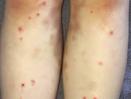 Infectious Mononucleosis Dermnet Nz