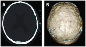 Copper beaten skull is the term used for a finding where it is not smooth but has inner markings, which correspond to the form of the brain gyri, the ridges on now the causes can be several, any process which results in increased pressure inside the skull could cause that appearance, such as a tumor. Copper Beaten Skull Bmj Case Reports