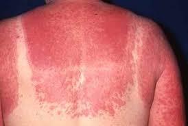 La Alergia Al Sol O Erupcion Polimorfa Luminica Epl