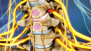 Though the lower back is more prone to experience a slipped disc, one can have a slipped disc in any part of the spine including the neck. C5 C6 Treatment