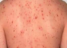 Image result for syphilis symptoms