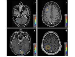 This article is updated throughout the day. Dose Distributions For Patients From 0 Mm Margin A And C And 2 Mm Download Scientific Diagram
