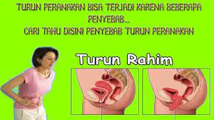 Tanda rahim jatuh dan senaman untuk merawatnya. Ini Dia Ciri Dan Gejala Terjadinya Masalah Turun Peranakan Youtube