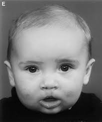 Nasoalveolar molding for infants born with clefts of the lip, alveolus, and  palate