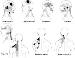 myofascial pain patterns showing the trigger point x and