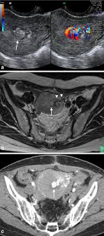 Role of clinical and ultrasound findings in the diagnosis of retained products of conception. Multimodality Imaging In Secondary Postpartum Or Postabortion Hemorrhage Retained Products Of Conception And Related Conditions Springerlink