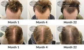 But do not block dht with drugs like propecia since it may affect your sex drive and hormone axis. Is Minoxidil Effective In The Long Term For Male Pattern Baldness