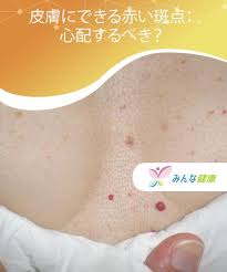 皮膚にできる赤い斑点 心配するべき みんな健康 皮膚 スキンケア 裏技ビューティー