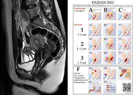 Eine endometriose trifft frauen im gebärfähigen alter. Mrt Bei Endometriose Radiologie Zentrum Neu Ulm Gunzburg