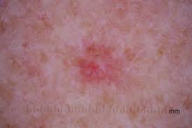 Of course, your specialist is the main person whose advice you should follow but it doesn't do anyone harm. Online Skin Cancer Tool Aims To Encourage People To Seek Early Medical Help Abc News