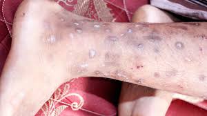 Image result for Skin Infection