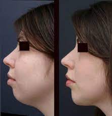 The Image Presents Microgenia Small Chin Before And After Liposuction Amazing Change Chin Liposuction Liposuction Chin Augmentation