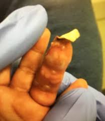 Image result for phlegmon of hand)