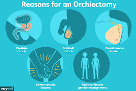 Your doc will examine you and let you know. Everything You Need To Know About An Orchiectomy