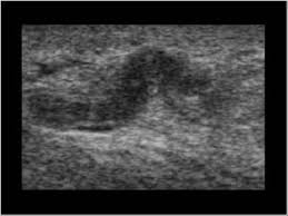 Radiology education videos mr bt ct radyoloji saglık radyografi radyoloji̇ mr. Urinary Tract And Male Reproductive System 2 3 Scrotum Case 2 3 16 Miscellaneous Scrotum Ultrasound Cases