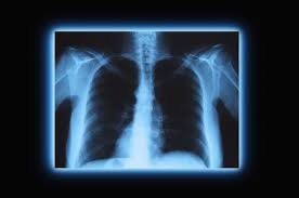 Apa Yang Anda Perlu Tahu Mengenai X Rays
