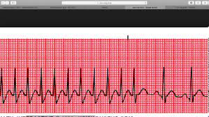 It can occur at any age and in people who. Paroxysmal Supraventricular Tachycardia Psvt Youtube