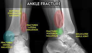 Symptoms may include pain, swelling, bruising, and an inability to walk on the leg. Ankle Fracture Surgery Dr Neal Blitz New York Nyc