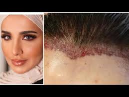تجربتي مع زراعة الشعر بمقدمة الراس سناب مريم الصفار اروما Youtube