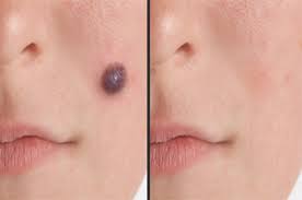 Yet skin cancer is preventable and the majority of skin cancers are treatable if detected early. Skin Cancer Surgery Palm Bay Fl Melanoma Treatment Melbourne Fl