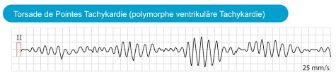 Qt Zeit Verlangerung Long Qt Syndrom Lqts Und Torsades De Pointes Tachykardie Ekg Echo