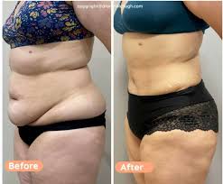 Image result for Liposuction