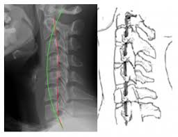 Background because loss of cervical lordosis leads to disrupted biomechanics, the natural lordotic curvature is considered to be an ideal posture for the cervical spine. Loss Of Neck Curve Reduces Blood Flow To The Brain The Spinal Centre