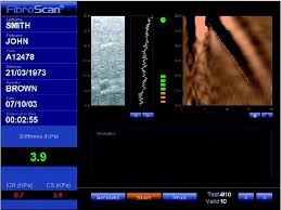 Fibroscan Hepcbc