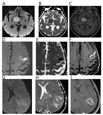 Damiano caruso (bahrain mclaren) logra la victoria en circuito de getxo. Cancers Free Full Text Diffusion Weighted Imaging In Oncology An Update