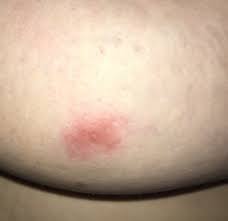 Inflammatory breast cancer is a rare but aggressive type of breast cancer in which cancerous cells affect the lymph vessels and the skin, according to it is more likely to affect younger women. Please Breast Discolor Bump Opinion Babycenter