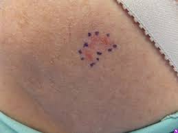 Red patch that may itch, hurt, crust, or bleed easily. Disease Management Nonmelanoma Skin Cancer