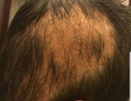 In genetic hair loss, the follicle's anagen phase starts to shorten. Why Does Shock Hair Loss After Hair Transplant Occur Clinicadvisor