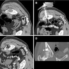 When they are caused by ovarian. Pdf Image Guided Ablation Of Painful Metastatic Bone Tumors A New And Effective Approach To A Difficult Problem