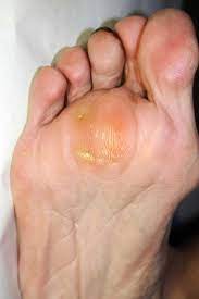 You should work on the reason for occurring calluses to avoid getting calluses. Corns And Calluses On Feet And Learn How To Get Rid Of Corns And Calluses