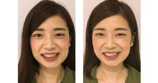 芸能人は歯がほにゃらら っていうコピーもあったけど 本当に 白い歯 っていいのかな Oggi Jp Oggi Jp