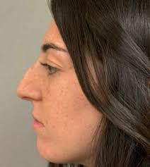 Rhinoplasty Before and After Photos