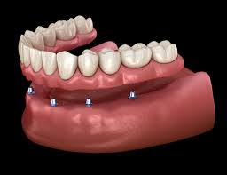 Other factors that affect the cost of dentures include the type of dentures to be used, the dentist's expertise, the insurance coverage a patient has, additional dental procedures needed. Implant Supported Dentures Kansas City Mo Dr Matthew Turner
