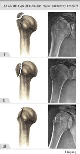 Image result for Fracture Type