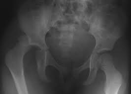 Pelvic ring formed from 2 innominate. Radiology In Ped Emerg Med Vol 6 Case 15