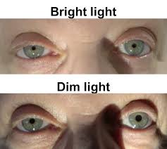 Horner S Syndrome Case Based Neuro Ophthalmology