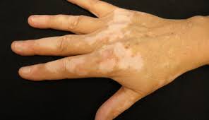 Image result for Vitiligo