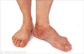 Stress fractures can occur anywhere there is overuse, but they're most commonly found in the lower extremity as a result using crutches to keep weight off your foot or leg until the bone heals. Stress Fracture Causes Symptoms Diagnosis Treatment