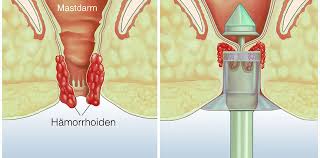 Wir erklären, wie viel blutverlust normal ist, und wann sie bei stark blutenden hämorrhoiden zum arzt. Hamorrhoiden Behandlung In Wien Empfehlungen Herold At